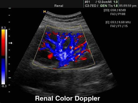 Ultrasound images • Kidney, color doppler, echogramm №108