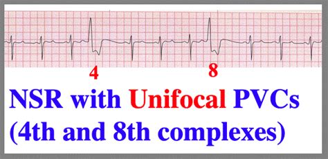 いろいろ sinus tachycardia with pvc 113144-Sinus tachycardia with pvc and pac