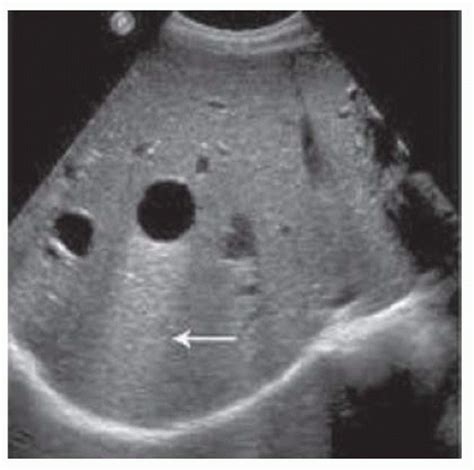 Intraoperative Ultrasound of the Liver | Basicmedical Key