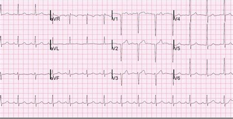 Dr. Smith's ECG Blog: Reversible T-wave inversion -- it reverses, then evolves, then reverses ...