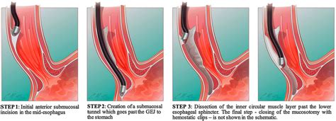 Schematic illustration of the steps involved in a peroral endoscopic ...