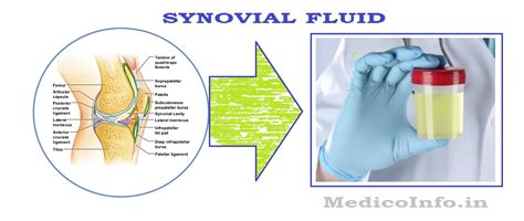 Synovial Fluid Collection & Analysis : Significance, Collection ...