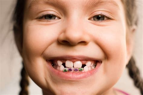 How Do Braces Move My Teeth | Issaquah Orthodontist | Dudley Smiles