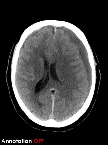 CT Brain - Scroll image gallery - Subdural Haematoma (SDH)