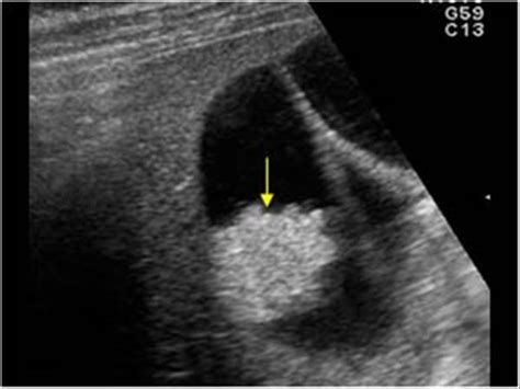 Abdomen and retroperitoneum | 1.2 Gallbladder and bile ducts : Case 1.2 ...