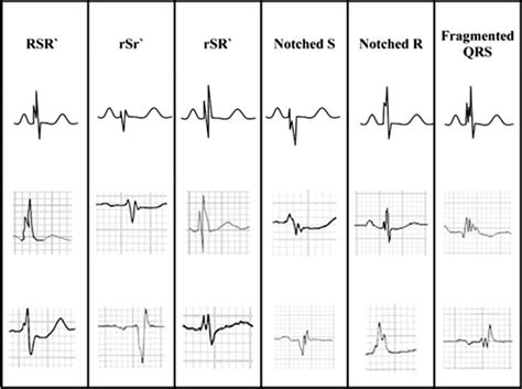 Surface Electrocardiogram Predictors of Sudden Cardiac Arrest | Ochsner ...