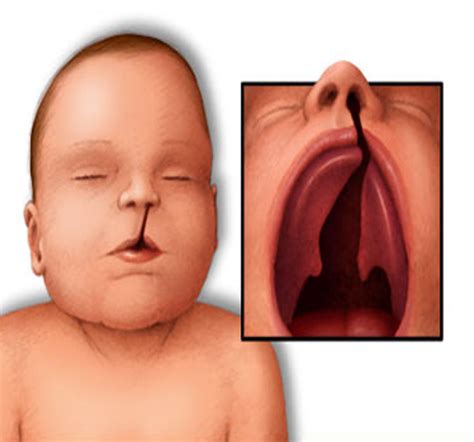 DiGeorge Syndrome - Pictures, Life Expectancy, Symptoms, Causes ...