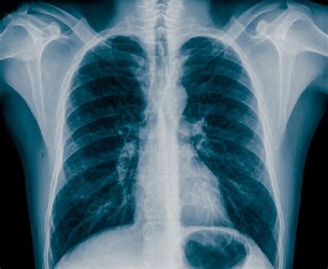 Understanding the Role of Chest X-Rays in Asthma Diagnosis