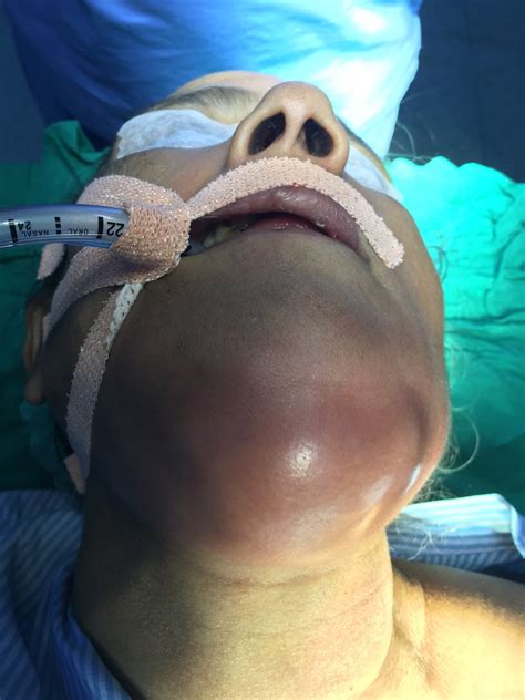 ENT Surgeon's blog: Submandibular and Submental cellulitis and abscess drainage.