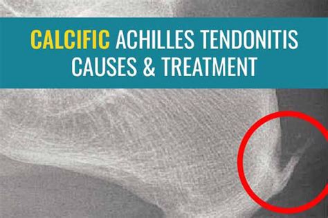 Calcific Achilles tendonitis: Causes and treatment