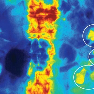 The Modern Realities of Kidney Stones: Diagnosis | Clinician Reviews