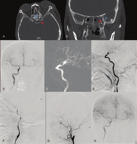 Figures from case 3. (A) and (B) The orbit computed tomography (CT ...