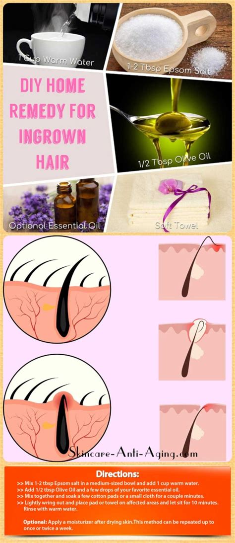 Home Remedies For Ingrown Hair - Human Hair Exim