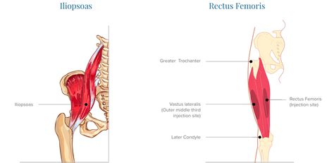 Hip Flexor Pain Causes