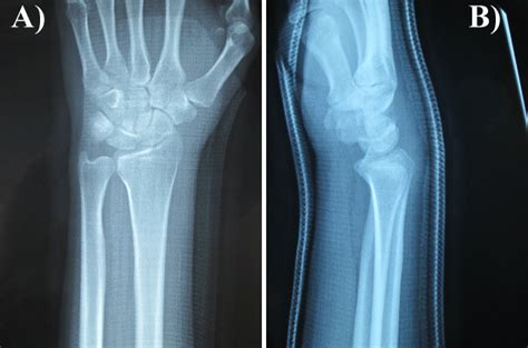 Radius Styloid Process Fractures Treated with Break-Away Screws: Two Cases Report