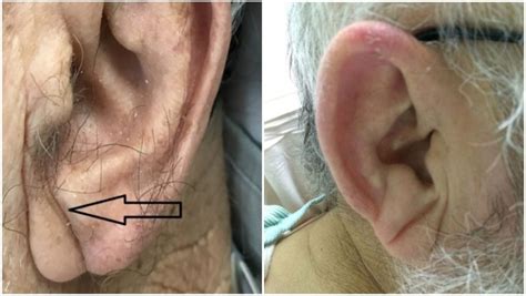 Do You Have A Crease On Your Earlobe? Indian Doctor Says It’s A Sign of Heart Disease | 🍏 LatestLY