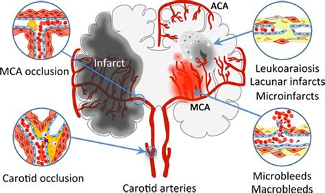 What is Vascular Dementia Symptoms, Causes, Stages & Life Expectancy