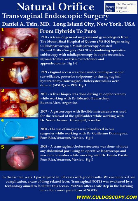 Pin on Natural Orifice Transluminal Endoscopic Surgery