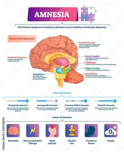 Amnesia vector illustration. Labeled brain memory loss disease types ...