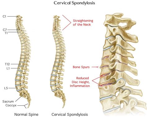 Cervical Spondylosis - Causes, Symptoms, Exercises, Treatment