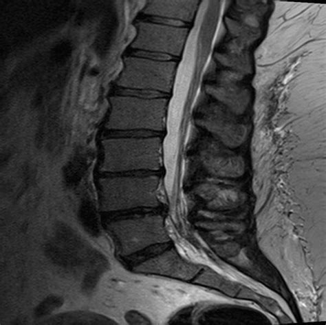 Neurogenic Claudication Symptoms – Study Spine A to Z