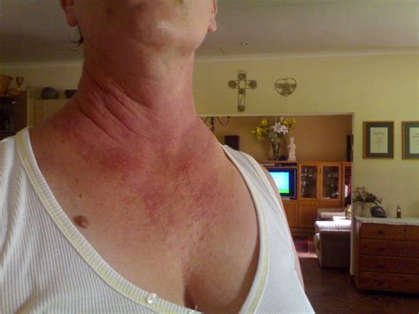 I have a rash on my neck and V-shap on my chest. It is itching