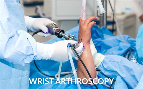 Wrist Arthroscopy - Dr. Saurabh Aggarwal