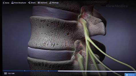 Dr. Sameer Mathur discusses how to perform a Lumbar Laminectomy - YouTube