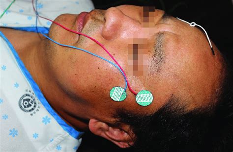 Patient under trigeminal somatosensory evoked potential test.... | Download Scientific Diagram