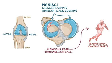 Medial Meniscus Tear