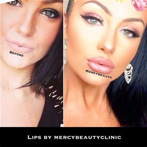 Image result for keyhole lip injections before and after pictures (With images) | Lip ...