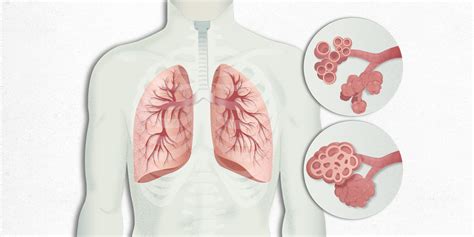 What is Pulmonary Fibrosis? | Hospital Clínic Barcelona