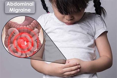 ABDOMINAL MIGRAINE – Symptoms, Diagnosis & Treatment - Expert Chikitsa