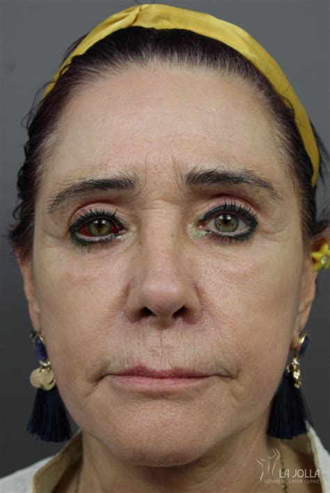 Sculptra® Before & After Gallery: Patient 7