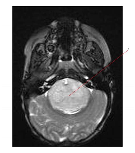 Glioma: Glioma Tumor In Brain Stem