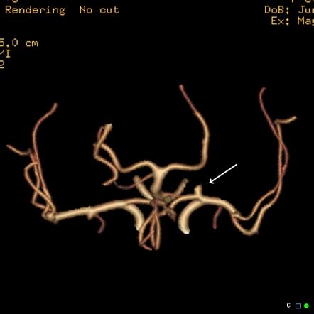 Terminal internal carotid artery berry aneurysm causing acute 3rd ...