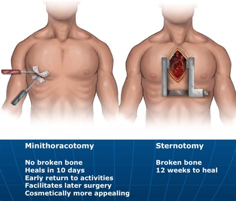 keyhole Aortic Valve Surgery | The Keyhole Heart Clinic