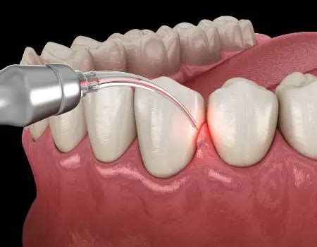 Laser Periodontal Therapy | Ivory Pointe Dentistry