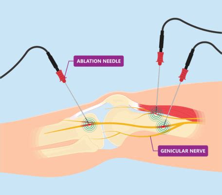 Should You Get Knee Nerve Ablation? - Regenexx