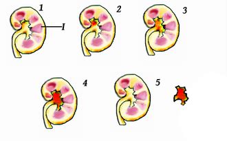 Kidney stone disease - Wikipedia