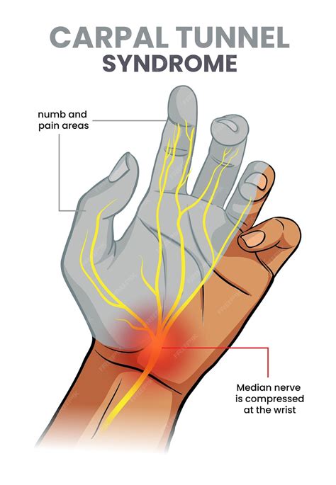 Premium Vector | Illustration of carpal tunnel syndrome