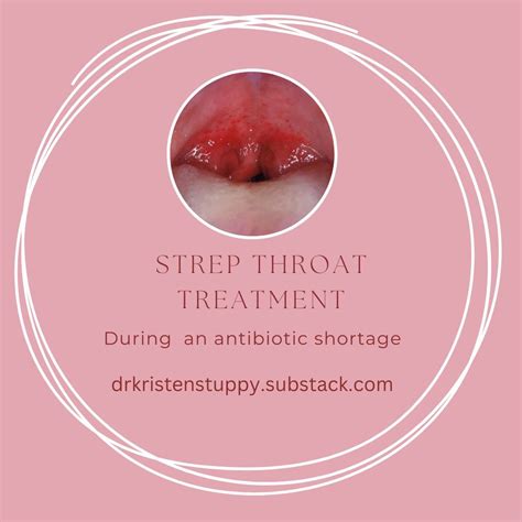 Strep throat treatment - by Dr. Kristen Stuppy