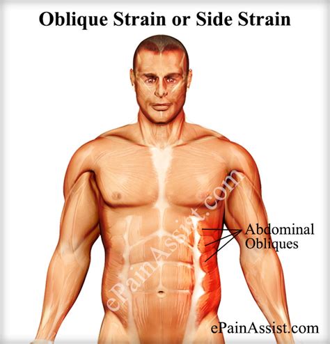 Oblique Strain or Side Strain|Causes|Symptoms|Treatment|Recovery Period