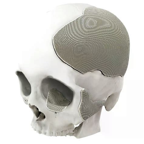 Custom-made cranial implant 3D Titanium - Alpha Medical