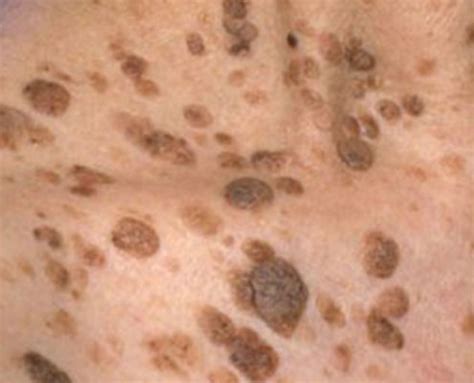 Seborrheic keratoses – All Dermatology