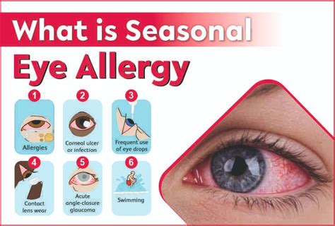 #1 What is seasonal eye allergy? (Causes of eye allergies) - Best eye specialist Hospital near ...