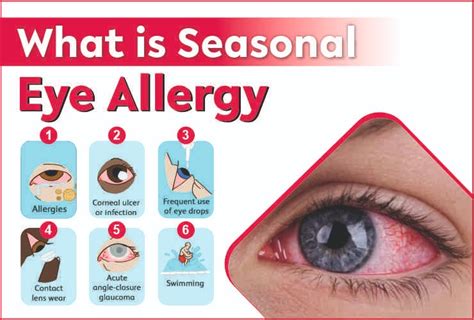 #1 What is seasonal eye allergy? (Causes of eye allergies) - Best eye ...