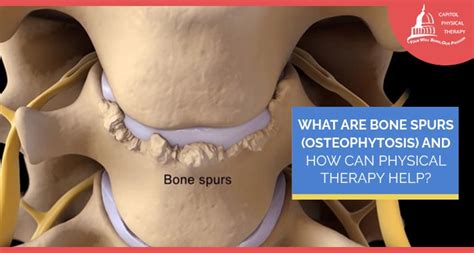 What Are Bone Spurs (Osteophytosis) And How Can Physical Therapy Help? | Capitol Physical ...