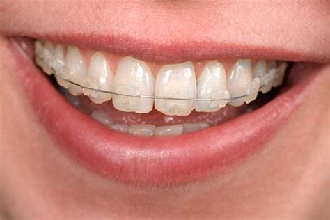 Clear Bracket Braces in Andover, MA | Andover Orthodontics