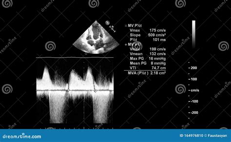 Screen of an Ultrasound Machine with a Heart Image Stock Photo - Image ...